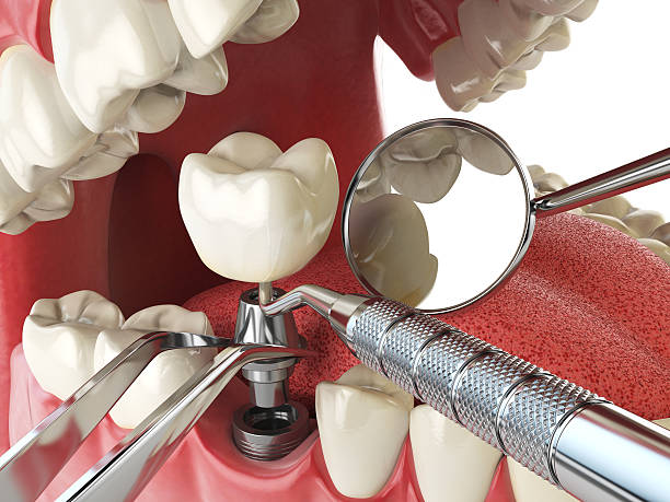 Best Emergency Treatment for Toothache in Choudrant, LA
